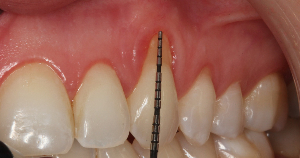 Soft Tissue Gum Graft | Before & After | Periodontist NYC