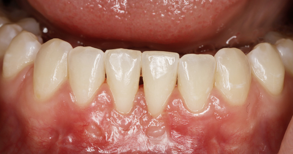 Soft Tissue Gum Graft | Before & After | Periodontist NYC