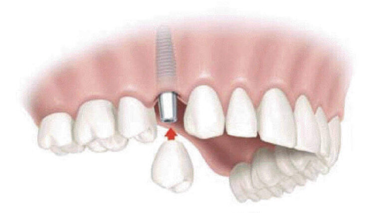 Dental Implant Problems Top Nyc Periodontist 