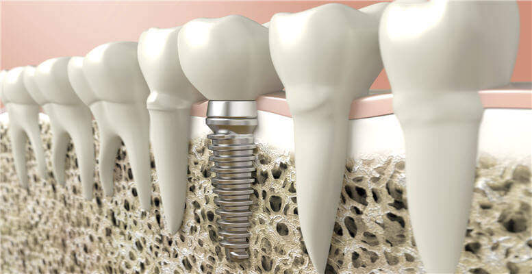 Dental Implant Pros and Cons