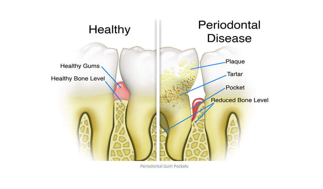 Gum Disease Treatment Midtown, NYC