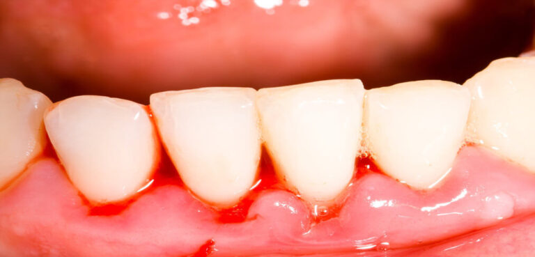 Diabetes Gum Disease? Look after Your Teeth and Gums!