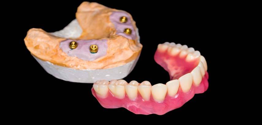 How Long Will It Take to Get Implant-Supported Denture