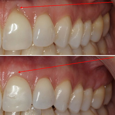 Soft Tissue Gum Graft | Before & After | Periodontist NYC