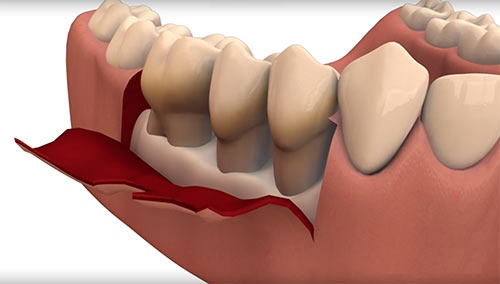 Periodontal Oral, Gum Surgery in Midtown Manhattan, NYC - Dr. Rahmani