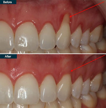 gingivitis before and after treatment